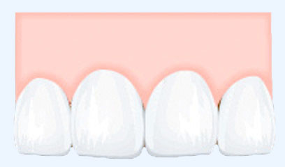 健康な歯肉は、歯と歯の間にスキマがなくキュッと引き締まっています。