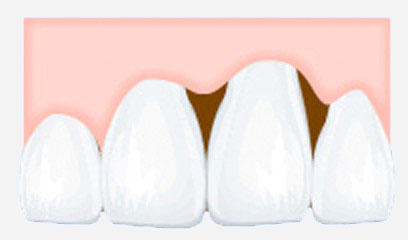 歯周病が進行すると骨が痩せて、歯肉も下がって（吸収されて）しまいます。