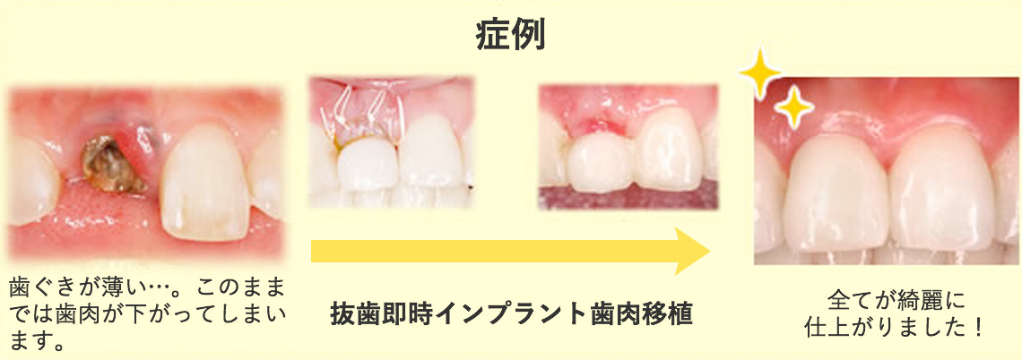 症例 抜歯即時インプラント歯肉移植