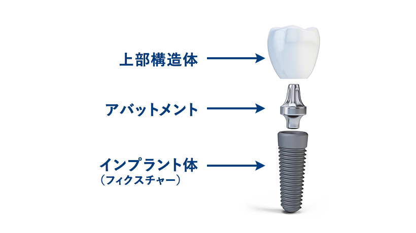 上部構造体 アバットメント インプラント体（フィクスチャー）