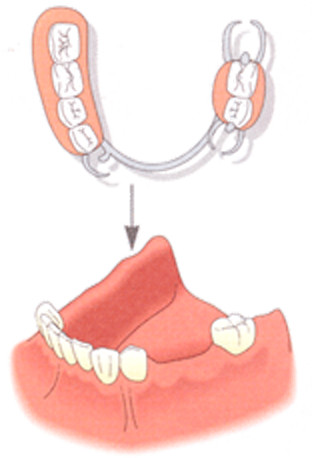 奥歯を固定するために金属の支えを使用する、部分入れ歯のケースです。装着には違和感があり、発音が不明瞭になったり痛みを伴う場合があります。また、見栄えも良くないので笑うと目立ってしまいます。