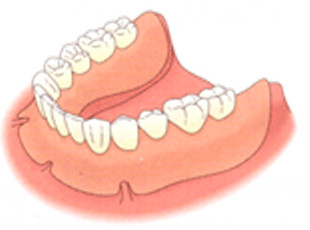 総入れ歯は固定する力が弱いため、簡単にぐらついたりズレたりします。そのため、食べ物を噛むために充分な力をかけることができません。会話中に入れ歯が取れそうな不安を感じる人もおられます。