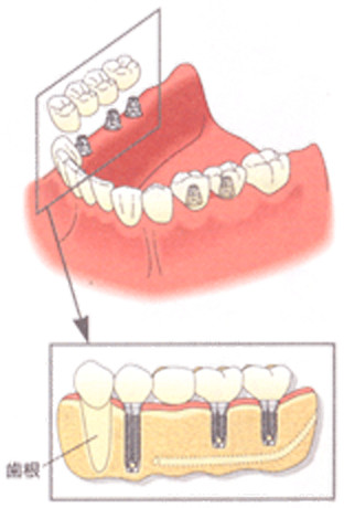 歯を失った箇所に人工歯根（インプラント）を埋入します。入れ歯のように取り外す必要もなく、特別なメンテナンスは必要ありません。