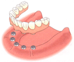 インプラントは骨に固定され、力を入れて噛むことができます。食感も天然歯に近く、食べる楽しみを取り戻せます。