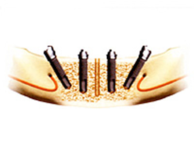 前歯部2箇所を形成し、インプラントを埋入します。その後にアバットメントを装着します。 
