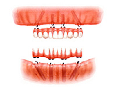 All-on-4は上顎でも下顎でも適応可能です。
