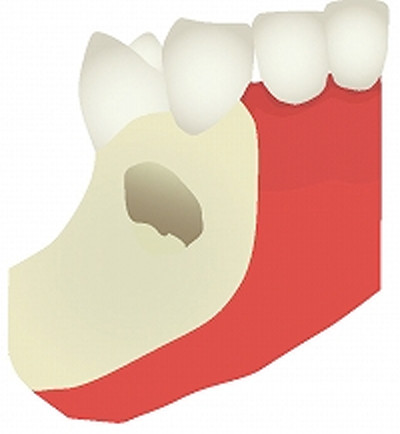 2.歯ぐきを切開して骨の状態を確認します。