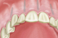 3．テンポラリーインプラント除去、人工歯装着