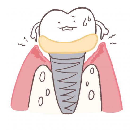 インプラント メンテナンスとは?長持ちさせるために知っておくべき全てのこと