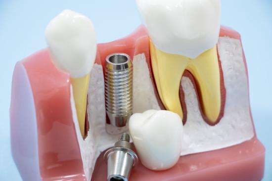 インプラント期間を徹底解説！ 治療の流れから短縮方法まで完全ガイド