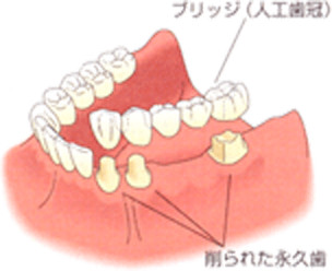 この形のブリッジを使うためには、周りの歯を大きく削らなければなりません。つまり、なくなった歯を補うために周囲の歯が犠牲にならなくてはいけないのです。