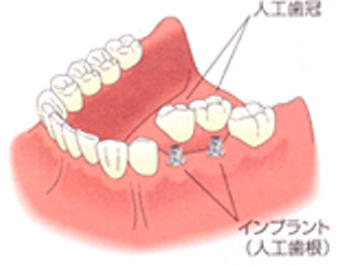 インプラント治療では、ブリッジ治療のように両隣の健康な歯を削る必要はありません。ですから、両隣の歯はそのままで負担もかかりません。