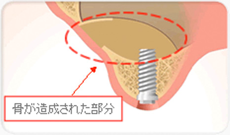 上顎洞底挙上術（サイナスリフト）