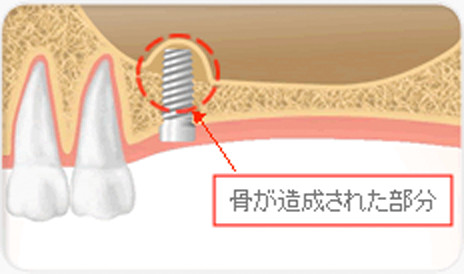 ソケットリフト