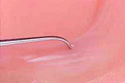 エキスプローラーという専用器具を使用します。