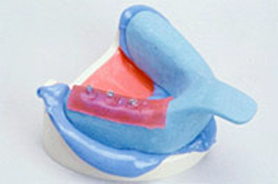 １．レジン（プラスチック）の仮歯の用意