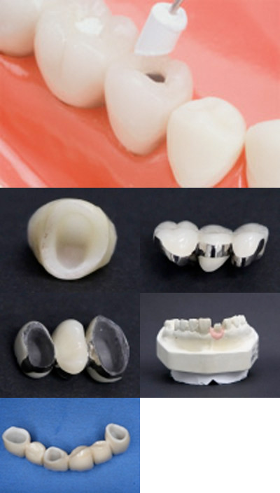 ３．本歯（セラミックの白い歯）