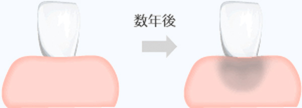 金属の問題点：歯ぐきが黒ずむ場合がある