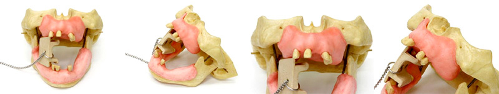 上顎左側部インプラント埋入＋サイナスリフト術（顎模型使用）