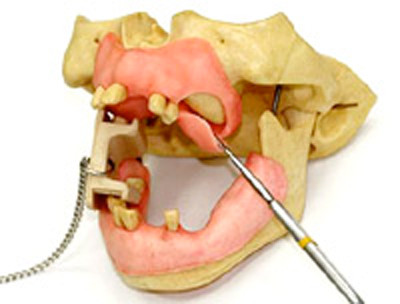 歯肉を剥離し、上顎骨前壁が見える状態にする