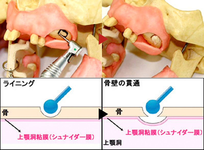 骨に穴を開ける