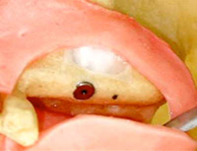 開けた穴を特殊な膜で塞ぎ、歯肉を縫合する