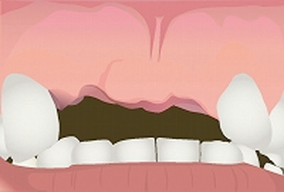 1. 治療前の歯肉の状態