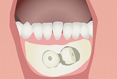 3.下のあごの中央部（前歯のすぐ下のあたり）の歯ぐきを切り開き、その部分の骨を専用の器具（トレフィンバー）を使い、ブロック状に骨を採取する。