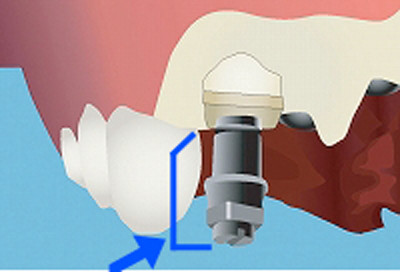 5.その状態でインプラントを埋入します。