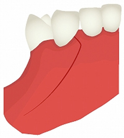 1.下顎臼歯部　7-4部にインプラント治療予定。