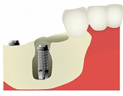 3.4部の歯を抜き、インプラントを埋入するが、骨がなく、インプラントがほとんど見えている。