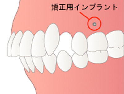 動かしたい歯の位置や動かす幅などに合った種類の矯正用インプラントを顎骨に埋入します。