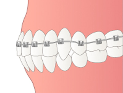 歯の移動が終わった後は、固定源としていたインプラントを除去します。<br />インプラントを除去した後の歯肉や顎骨は、1週間程度で元に戻り、跡が残る心配もありません。