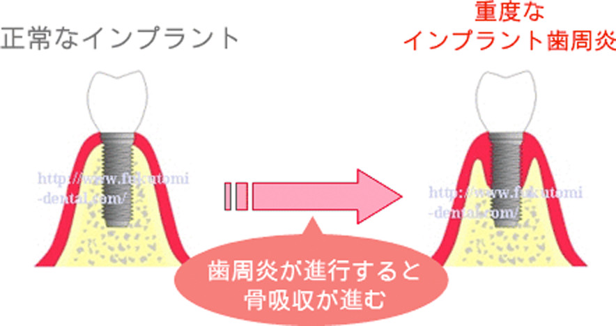 正常なインプラント 重度なインプラント歯周炎