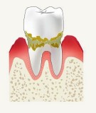 歯周病