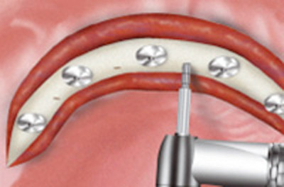 1．インプラント埋入